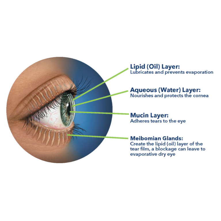 Dry Eye Disease - Redmond Eye Clinic