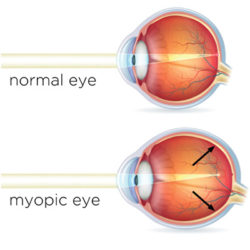 Myopia Treatment Program - Redmond Eye Clinic